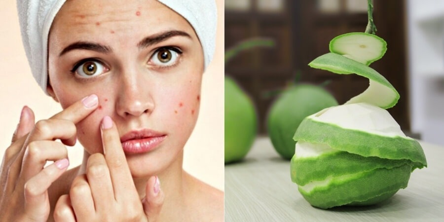 Tinh dầu bưởi dùng để làm gì giảm tình trạng mụn trứng cá