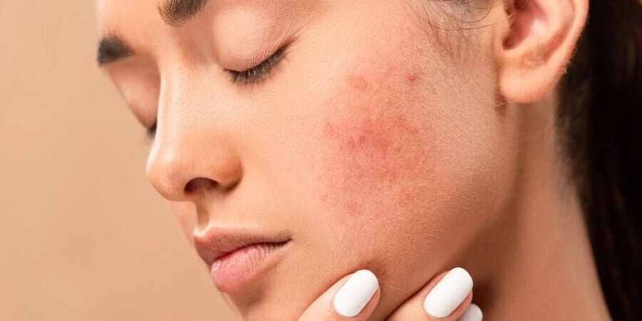 Tinh dầu bơ làm đẹp chăm sóc da dễ nổi mụn