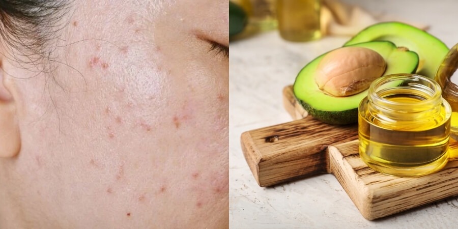 Cách làm tinh dầu bơ chăm sóc da không nổi mụn